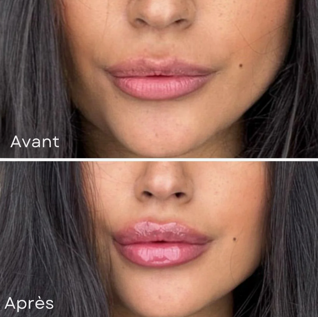 Lip Boost Roller® - Microneedling lèvres