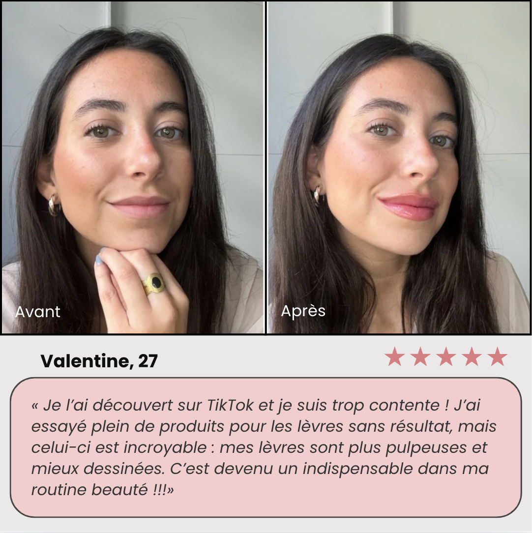 Lip Boost Roller® - Microneedling lèvres
