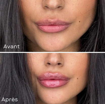 Lip Boost Roller® - Microneedling lèvres